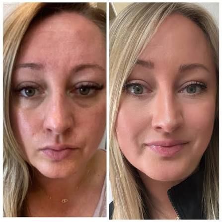 Before and after — Hannah G.
