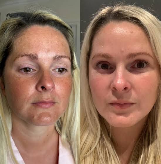Before and after — Olivia K.